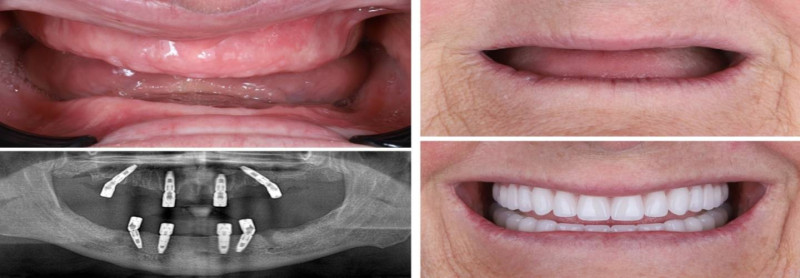 My Implant Dentist South Perth